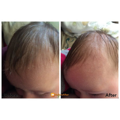 MOOGOO Scalp Cream | Cradle Cap and Seborrheic Dermatitis