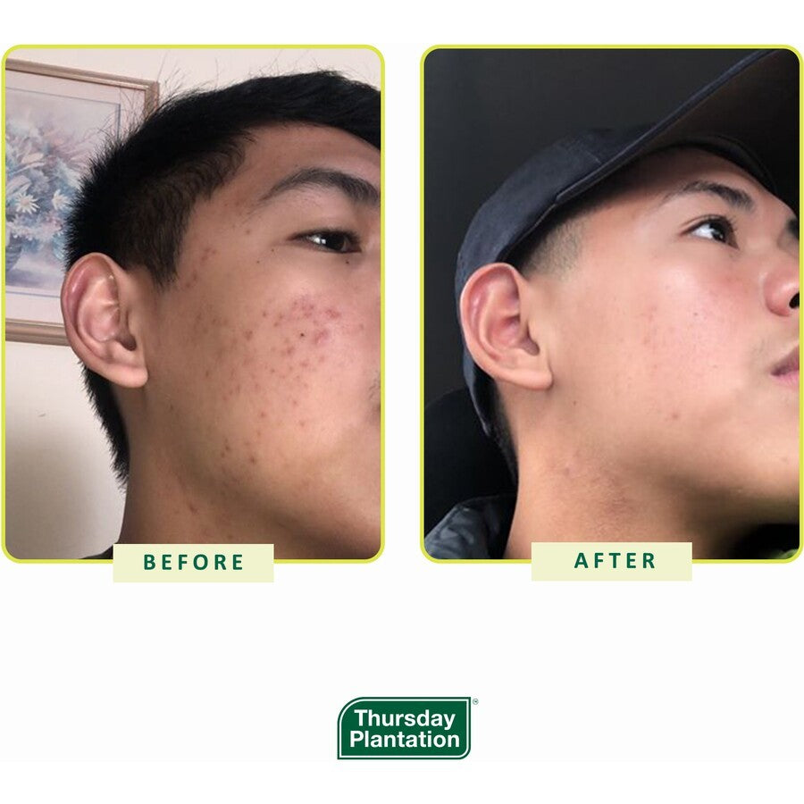 Thursday Plantation Tea Tree Gel For Acne 25g