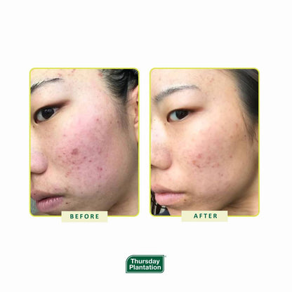 Thursday Plantation Tea Tree & Witch Hazel Face Toner 100mL